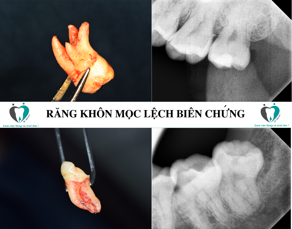 Nhổ răng khôn khó hay dễ?