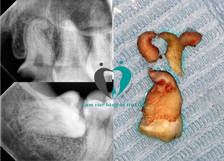 Ca nhổ răng khôn khó: sâu vỡ lớn, chân răng cong dị dạng!
