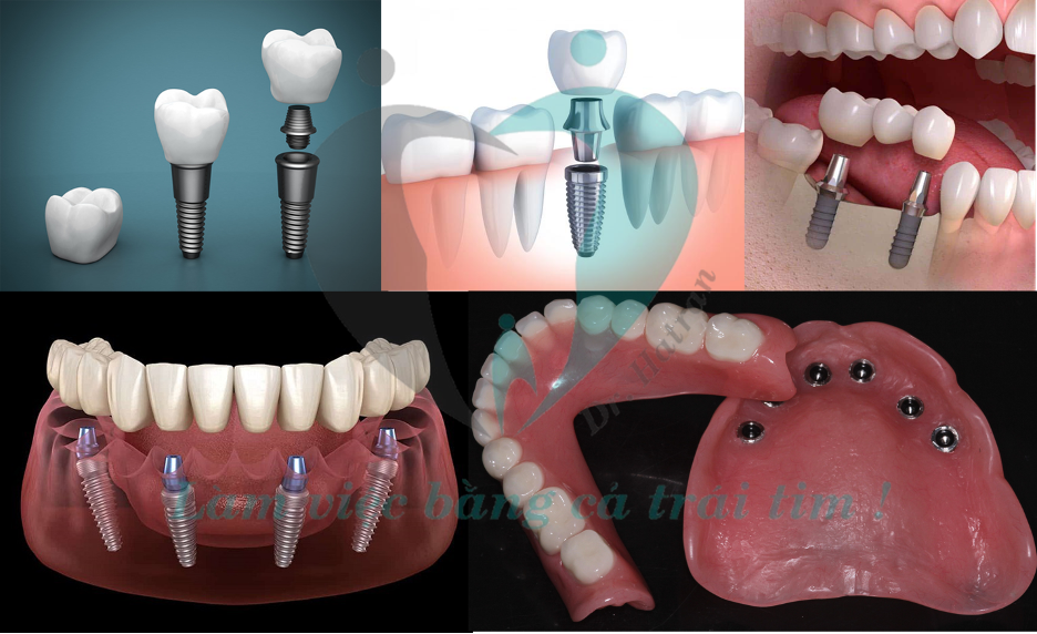 Cấy ghép implant nha khoa là gì?