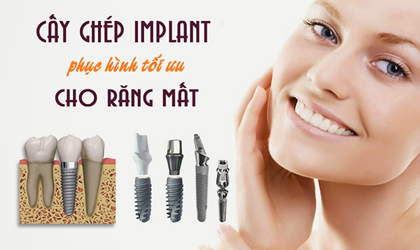 Ưu điểm của phương pháp cấy ghép implant?