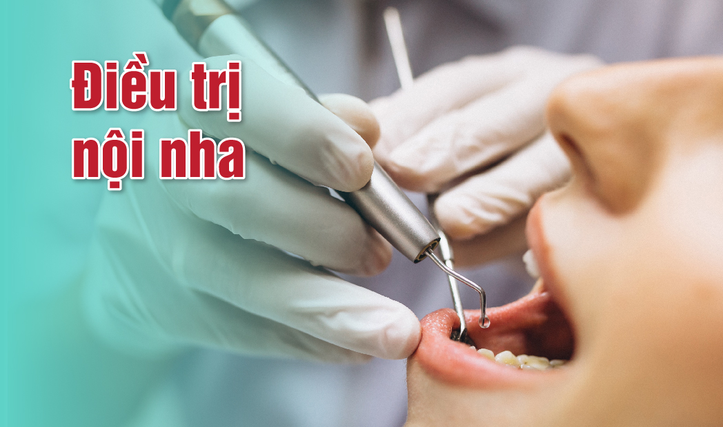 Điều trị Nội Nha - Giải pháp cuối cùng để bảo tồn răng