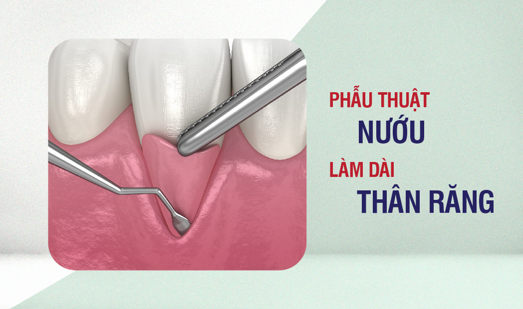 Điều trị cười hở lợi bằng phương pháp phẫu thuật cắt nướu làm dài thân răng