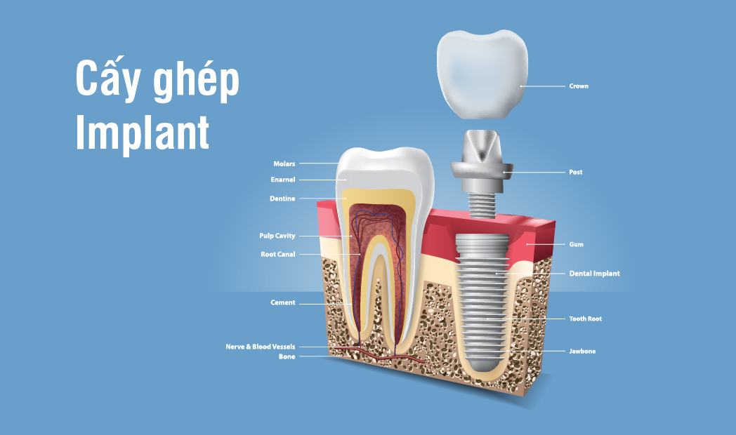 TRỒNG RĂNG IMPLANT - GIẢI PHÁP KHÔI PHỤC HOÀN TOÀN MẤT 1 RĂNG - NHIỀU RĂNG - TOÀN HÀM