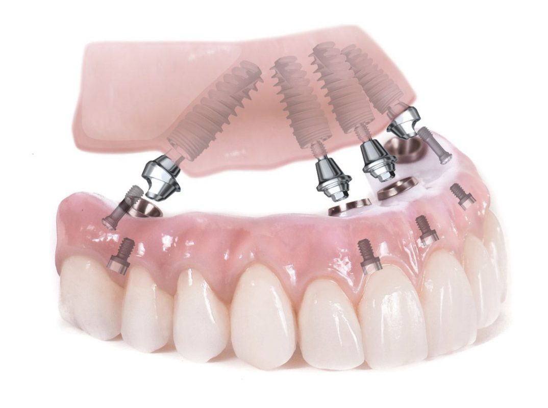 Cấy Ghép Implant All On 4 - Cho Bệnh Nhân Mất Răng Toàn Hàm