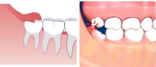 Răng khôn mọc thẳng, nên giữ hay phải nhổ?