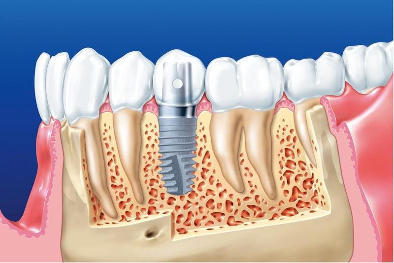 Trồng răng implant là gì?