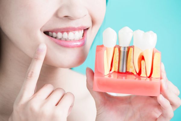 Nên cấy ghép Implant ở đâu?