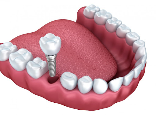 Cấy ghép Implant mất thời gian bao lâu?