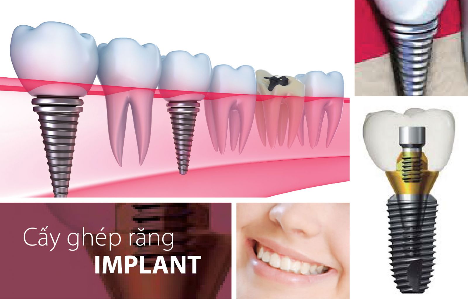 Cấy ghép Implant có an toàn hay không?