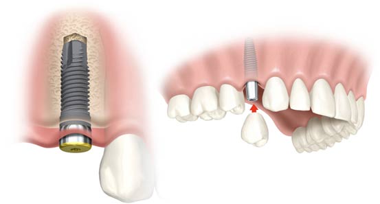 Trồng Implant mất bao lâu?