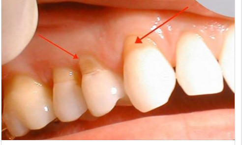 ​Mòn cổ chân răng là gì?