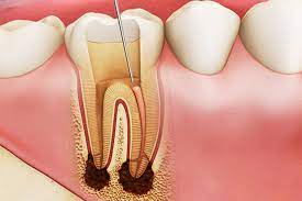 Điều trị tủy răng cửa