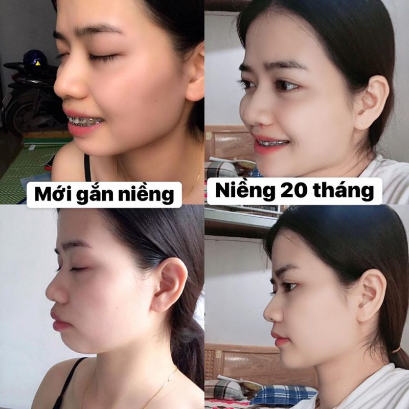 Niềng răng mất bao lâu thì đẹp?