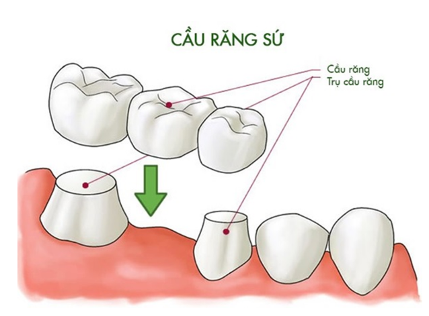 Cầu răng sứ là gì?