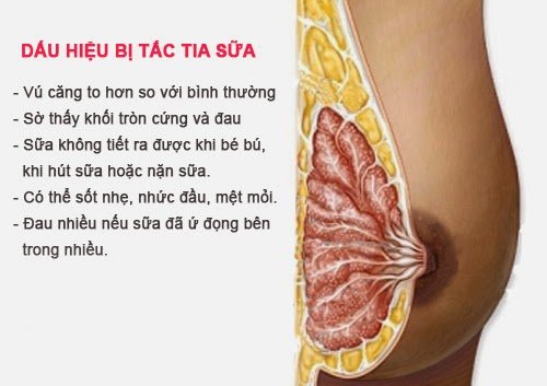 Dịch vụ thông tắc tia sữa tại nhà