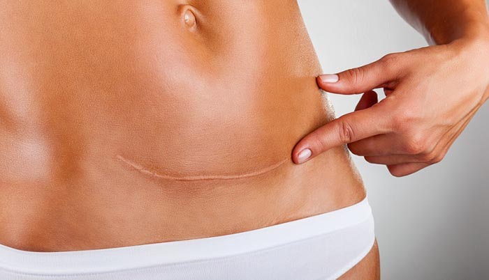 Kinh nghiệm chăm sóc sản phụ sau sinh mổ