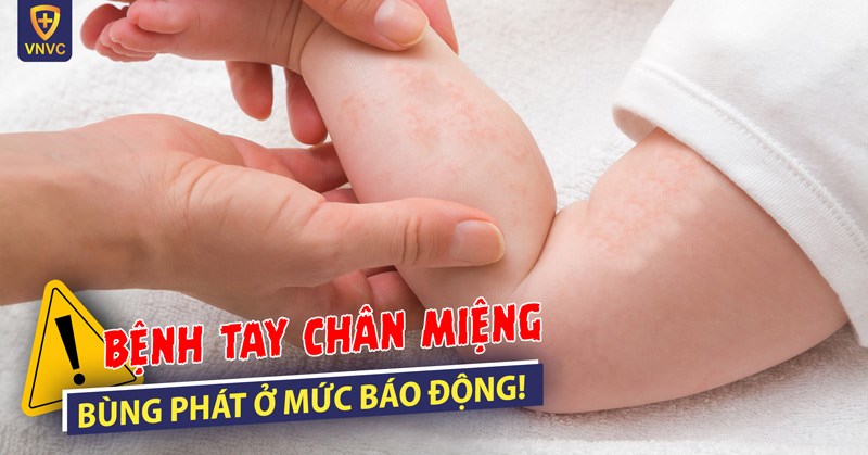 Không chỉ tay chân miệng, nhiều dịch bệnh khác cũng đang vào mùa